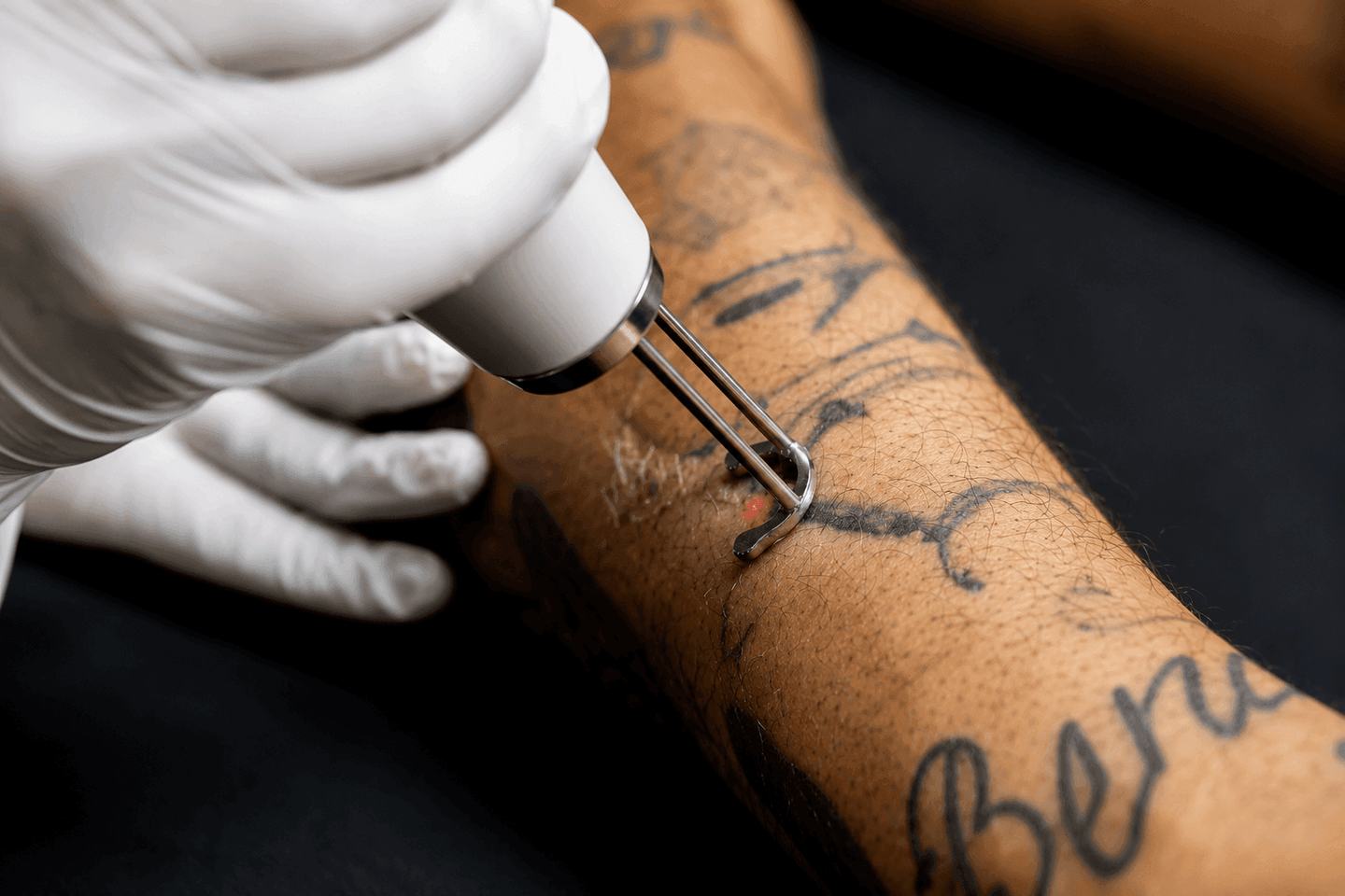 Close-up of laser tattoo lightening in Birmingham at VEAN TATTOO