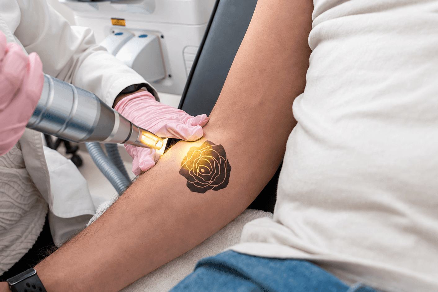 Laser tattoo removal on forearm