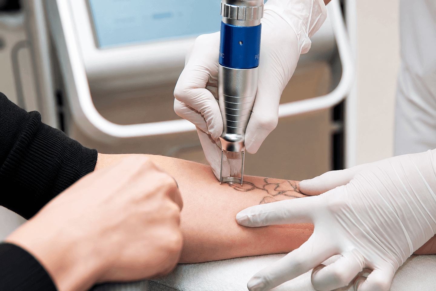 Laser tattoo removal on arm