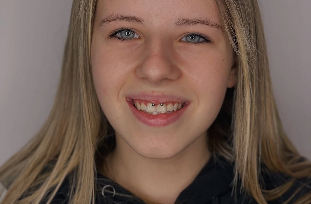 Lip piercing