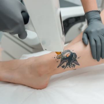 Close-up of a gloved specialist applying laser pulses to a black-and-colour ankle tattoo