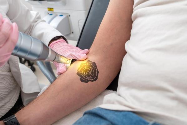 Laser tattoo lightening on forearm