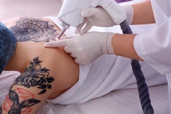 Laser tattoo lightening on leg