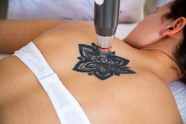 Laser tattoo lightening on upper back