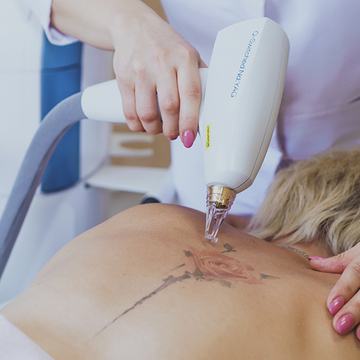Laser tattoo lightening session in Bristol