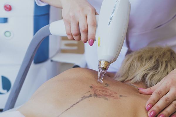 Specialist performs laser tattoo lightening with a Q-switched