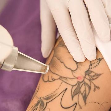 Close-up of a gloved specialist using a laser handpiece to lighten