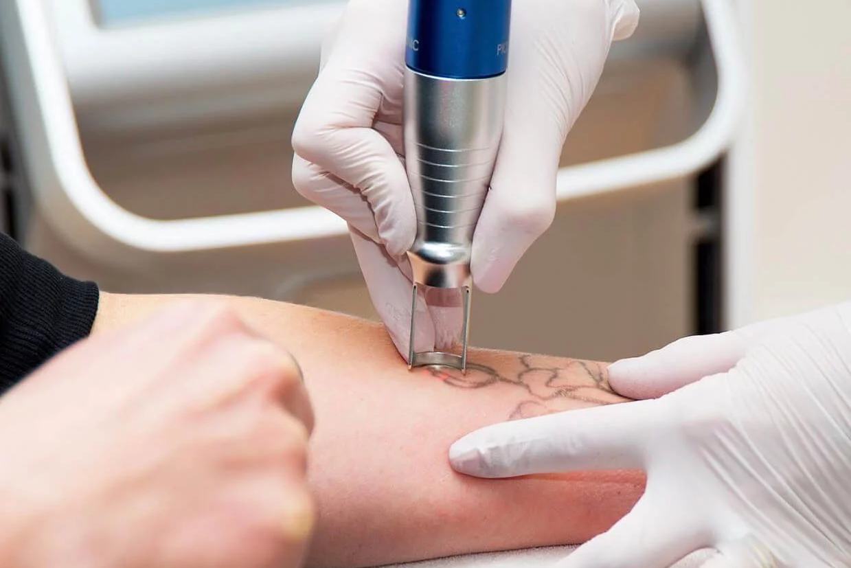 Laser tattoo lightening on arm