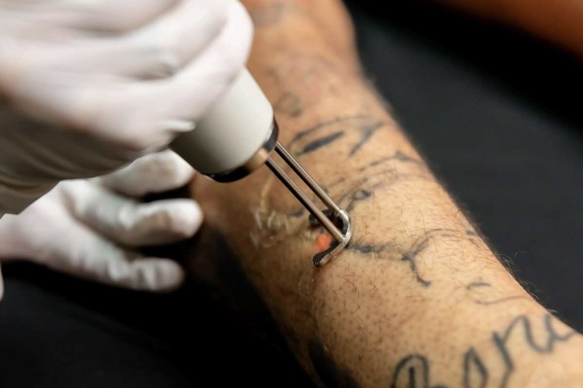 Close-up of laser tattoo lightening in Birmingham at VEAN TATTOO