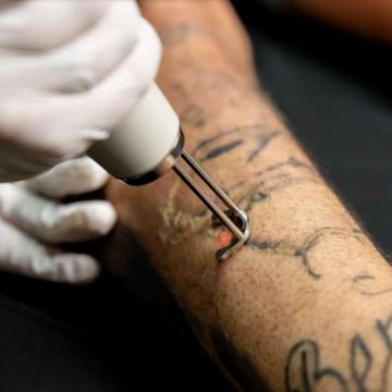 Close-up of laser tattoo lightening on a forearm in Bristol
