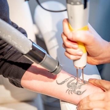 Laser tattoo lightening on wrist