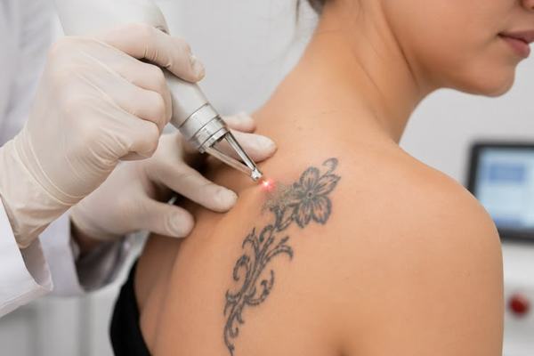 Client wearing protective goggles receives laser tattoo lightening on a black floral shoulder tattoo