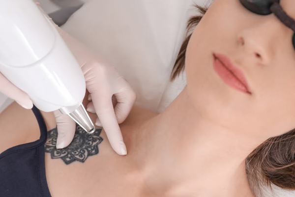 Laser tattoo lightening