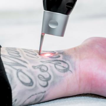 Laser tattoo lightening on arm