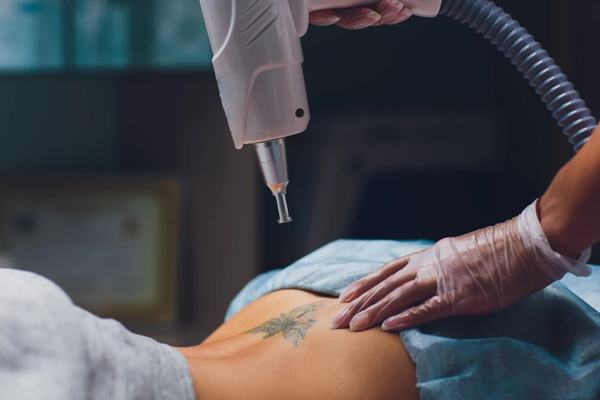 Close-up of a gloved specialist using a laser device to lighten a black floral tattoo