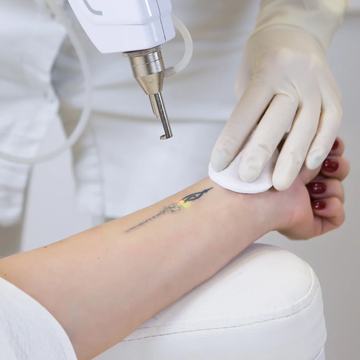 Laser tattoo lightening on wrist