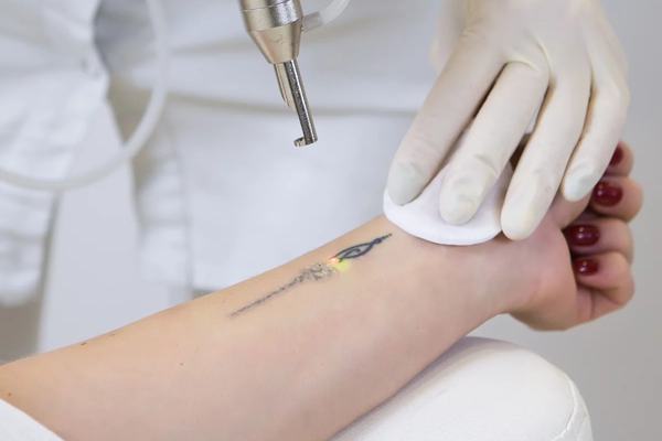 Close-up of laser tattoo lightening at VEAN TATTOO Birmingham