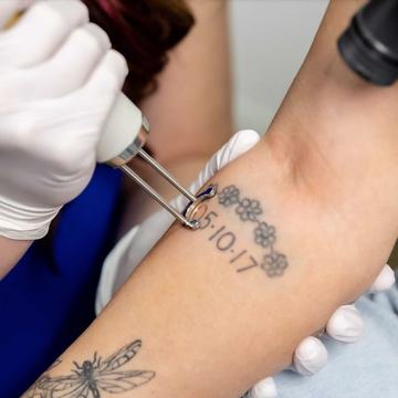 Close-up of a gloved specialist applying laser pulses to lighten a black floral-and-date forearm tattoo, illustrating professional, controlled tattoo fading in Bristol.