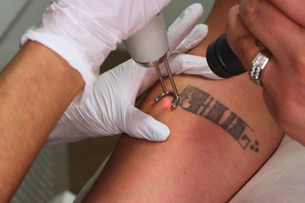 Close-up of a laser handpiece delivering a red pulse to the skin