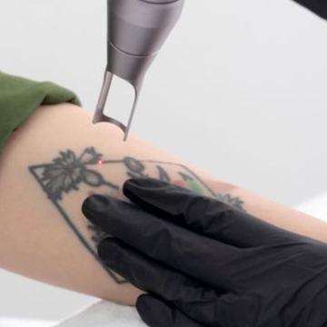 Laser tattoo lightening on wrist