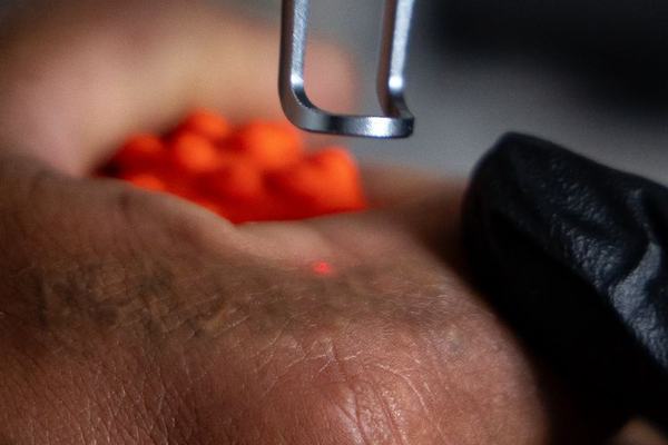 Close-up of a gloved specialist using a laser handpiece
